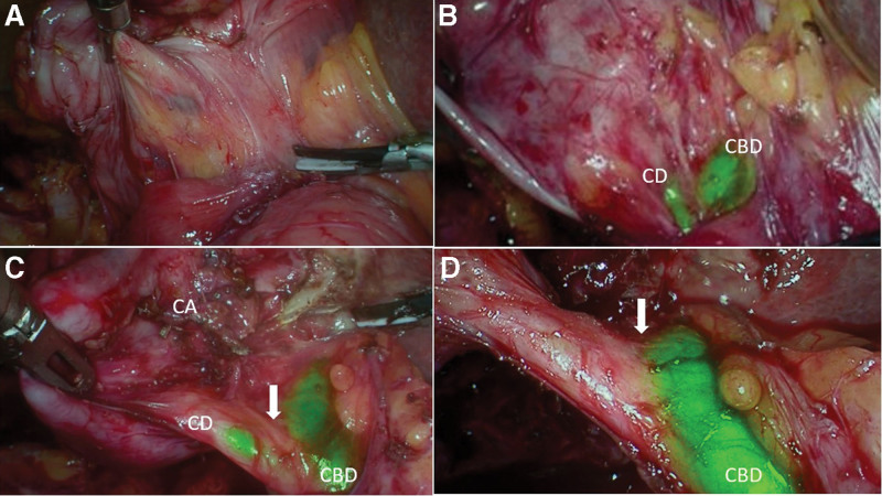 (a) Pure laparoscopic image showing obscure hepatocystic triangle; (b) ICGF showing location of cystic duct and CBD: (c) ICGF after further dissection showing cystic artery, cystic duct and CBD, arrow showing cystic duct-CBD junction; (d) ICGF demonstrating cystic duct, CBD and common hepatic duct prior to clipping of cystic duct, arrow showing cystic duct-CBD junction. CBD = common bile duct, ICGF = ICG fluorescence.
