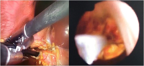 Intraoperative trans-cystic Choledocoscope