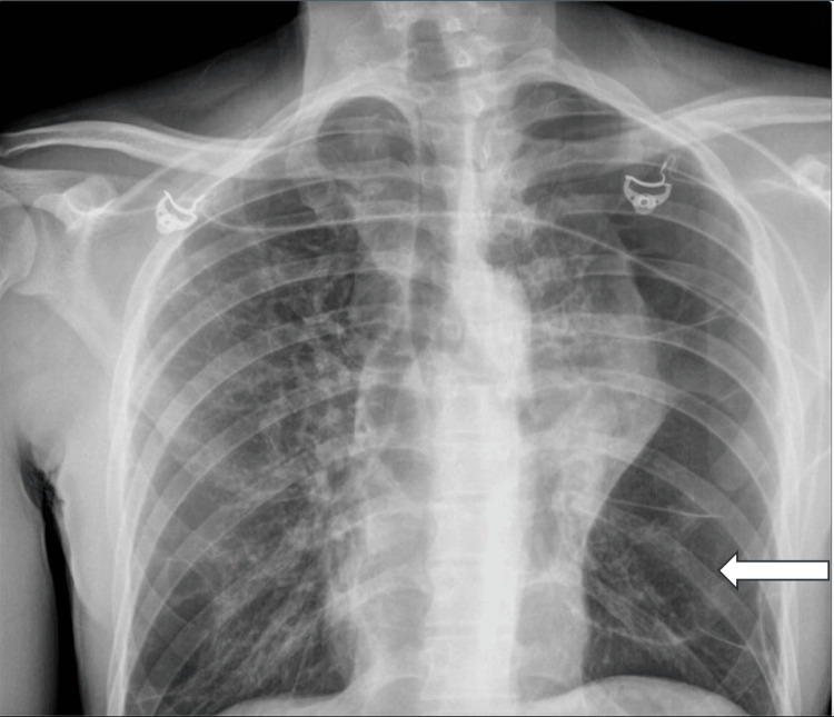 Portable chest radiography during admission showing marked lucency at the lateral aspect of the left lung.
