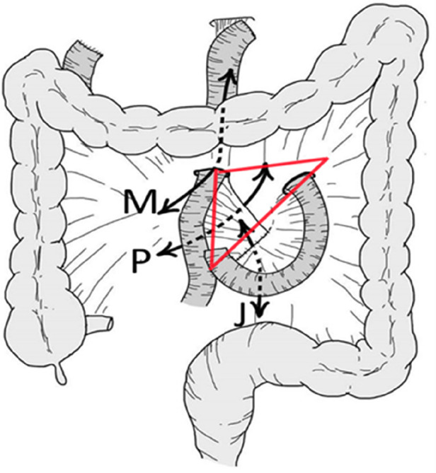 P: defect between Roux limb mesentery and transverse mesocolon (Petersen space), J: defect at jejunojejunostomy (Brolin space), and M: defect in transverse mesocolon (retrocolic approach) (3, 20, 21). The red triangle represents the internal hernia triangle.