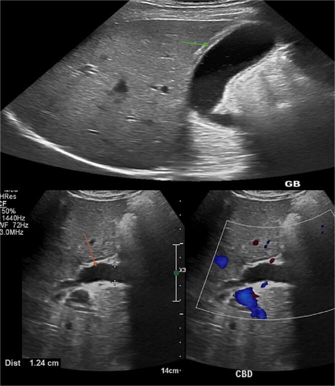 Abdominal axial ultrasound of the liver and gallbladder shows thick edematous gallbladder wall and a dilated common bile duct with intrahepatic biliary dilatation.