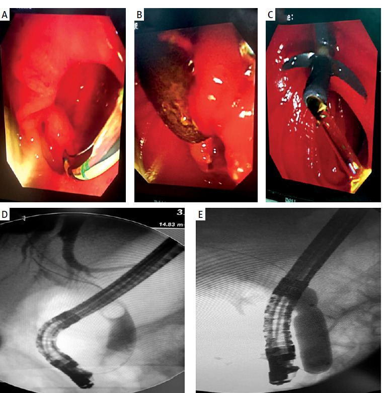 A – Type 2 PAD and cannulation by sphincterotomy. B – Large stone out of papilla after extraction by balloon extractor. C – Stent in place with good biliary drainage. D – Large filling defect (stone) in CBD by cholangiogram. E – Balloon sphincteroplasty
