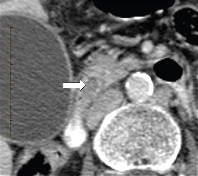 An 81-year-old woman with a clinical picture of obstructive jaundice. This is an IV contrast-enhanced transverse MDCT images with positive intraduodenal contrast filling. Both observers and the original CT reading described a crescent-like homogenously calcified distal CBD stone (straight arrow). The ERCP performed one day after the CT showed no stones. The third reader concluded that this stone had likely passed in the interim
