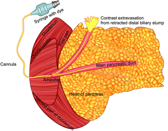 Pictorial depiction of TAG; duodenal ampulla was cannulated and dye was injected to delineate the anatomy of the bile duct and pancreatic duct around the PBJ