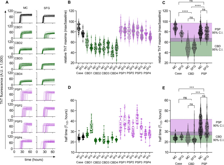 Tau RT-QuIC classification of Case 1. A Raw RT-QuIC traces of Case 1, CBD, PSP cases run in 32 replicates per indicated sample; MC, motor cortex; SFG, superior frontal gyrus. B Violin plots relative ThT maxima calculated by dividing peak ThT fluorescence values in panel A by baseline fluorescence values, points represent an individual trace from panel A. C Clustered peak ThT maxima analysis of Case 1 compared to known CBD and PSP cases; shaded areas represent 95% confidence intervals of all CBD cases (MC and SFG) versus all PSP cases (MC and SFG) by simple t-test; Asterisks represent p < 0.0001 by ordinary one-way ANOVA with multiple comparisons; ns, nonsignificant difference. D Half times of reactions in panel A calculated by simple sigmoidal dose–response fitting; boxes represent the interquartile range, whiskers represent outer quartiles (E) clustered T1/2 values of Case 1 compared to known CBD and PSP cases; shaded areas represent 90% confidence intervals of all CBD cases (MC and SFG) versus all PSP cases (MC and SFG) by simple t-test; Asterisks represent p < 0.001 by ordinary one-way ANOVA with multiple comparisons