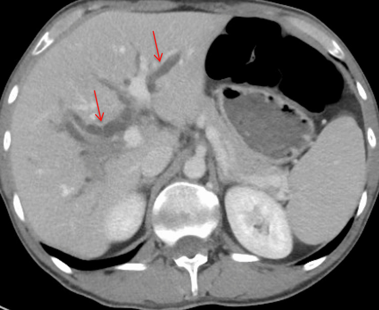 CT abdomen and pelvis with intravenous contrast (axial view) demonstrating intrahepatic and extrahepatic biliary ductal dilation (red arrows) with the CBD measuring up to 11 mm.CBD: common bile duct