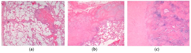 Pulmonary sarcoidosis. (a) Pulmonary sarcoidosis. (b) Pulmonary nodular sarcoidosis. (c) Pulmonary fibrotic sarcoidosis. H&E. Magnifications 20×, 50×.