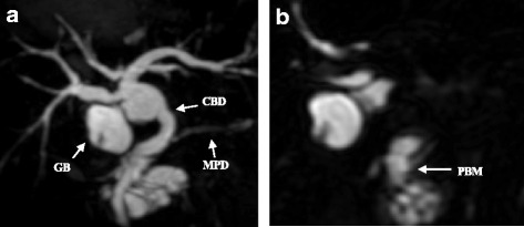 a, b Magnetic resonance imaging (MRI) showed a pancreaticobiliary maljunction with cystic dilatation of the common bile duct (type Ia [Todani classification]). GB gallbladder, CBD common bile duct, MPD main pancreatic duct, PBM pancreaticobiliary maljunction