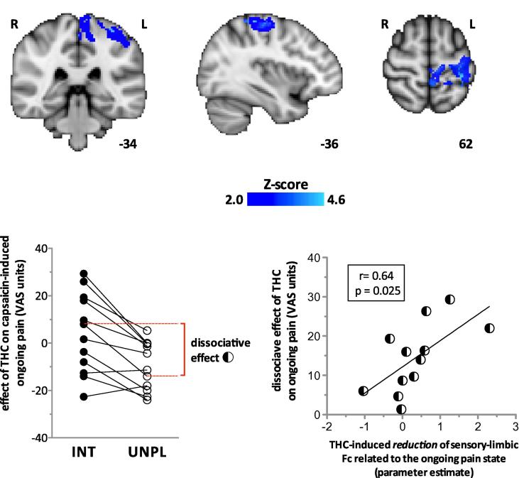 (Top) Delta-9-tetrahydrocannabinol (THC) significantly reduced the right amygdala and primary sensorimotor functional connectivity (Fc) during capsaicin-induced ongoing pain (z > 2.0; cluster-based correction). z-Scores indicating the degree to which THC reduced Fc are scaled in blue. Montreal Neurological Institute (MNI) coordinates are indicated at the bottom right of each slice. (Bottom-left graph) The dissociate effect that THC has on the intensity (INT) and unpleasantness (UNPL) of capsaicin-induced pain in each individual (represented by connecting lines). Negative visual analogue scale (VAS) units on the Y-axis indicate an analgesic effect. The dissociative effect of THC on pain was calculated as the absolute difference of drug effects on the intensity and unpleasantness of ongoing pain, and is indicated in dashed red lines and bracket for an individual. (Bottom-right graph) THC-induced reduction of sensory-limbic Fc was positively correlated with the dissociative effect of the drug on ongoing pain. The interaction term for the drug effect on the sensory-limbic Fc associated with ongoing pain is drug [PLC-THC] × state [CAP-CON]. For each individual, parameter estimates for the interaction effect were calculated for the left-S1 region of interest, which consisted of an 8-mm-diameter sphere centred on the group peak interaction (state × drug) effect within the post-central gyrus (MNI coordinates −34, −36, 62). PLC, placebo; CAP, capsaicin-sensitised state; CON, control state.