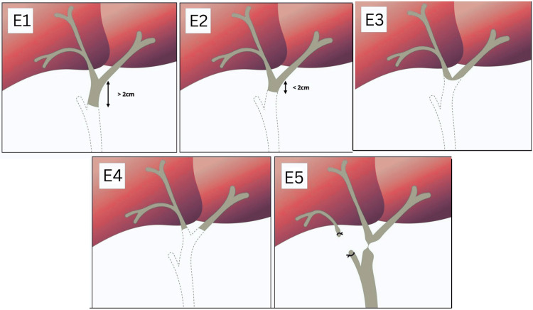 Strasberg classification of bile duct injuries.Original illustration created by the authors using Microsoft PowerPoint based on information from Radiopaedia.org [7] (Creative Commons Attribution-NonCommercial-ShareAlike 3.0 Unported (CC BY-NC-SA 3.0))