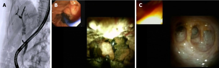 Management of impacted common bile duct stones with distal biliary stricture by cholangioscopy assisted lithotripsy. A: Cholangiogram showing distal common bile duct (CBD) stricture with large impacted stone in the medium CBD and multiple stones above; B: Cholangioscopy assisted lithotripsy by electrohydraulic of the impacted stone; C: Final cholangioscopy showing complete CBD clearance with biliary confluence appearance.