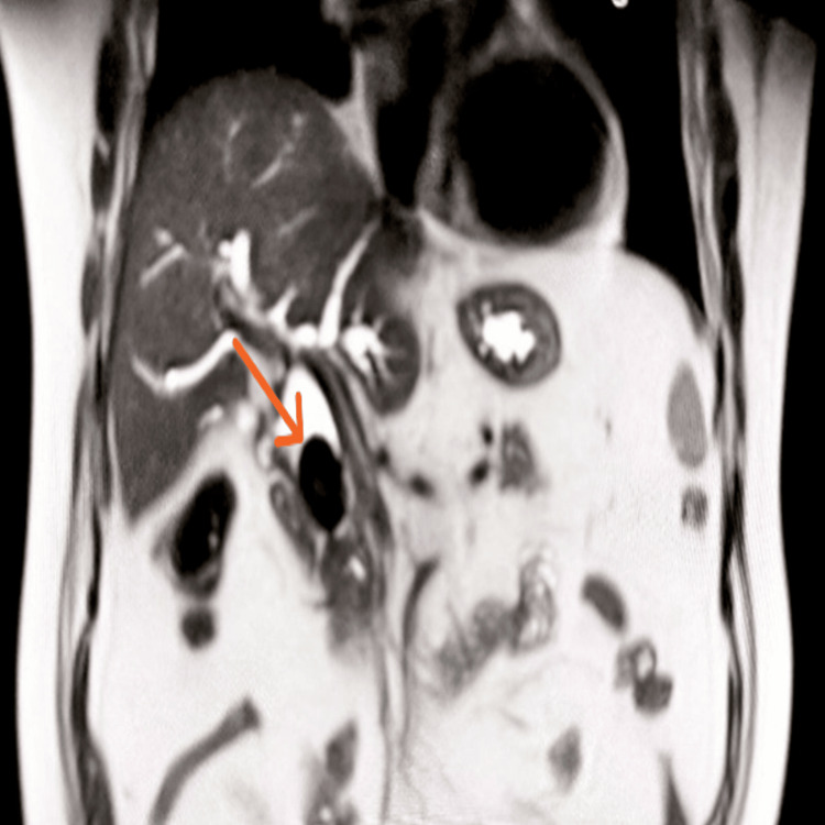 Coronal T2-weighted MRI image showing an intraductal filling defect in the region of the mid common bile duct (CBD), suggestive of an intraductal calculus
