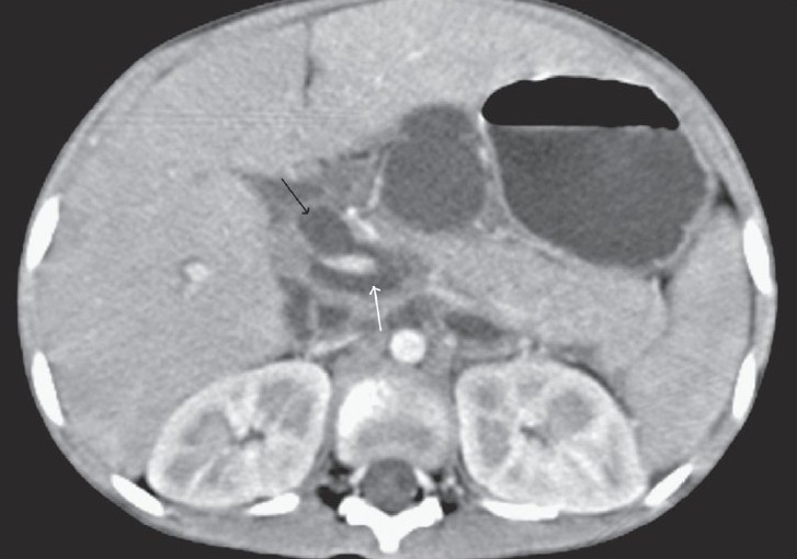 Transaxial contrast-enhanced CT scan shows a dilated suprapancreatic CBD (black arrow) communicating with a retroperitoneal collection (white arrow) that is surrounding the portal venous confluence