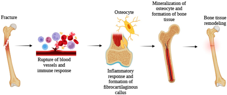 Illustrative diagram of the bone regeneration process, consisting of the formation of a hematoma resulting from the rupture of blood vessels at the time of injury. This fact stimulates the immune system’s response, which attracts bone progenitors. Thus, the chondrocytes form a fibrocartilaginous tissue that subsequently hypertrophies and forms new bone tissue, which will undergo several remodelings to adapt to the new tissue. Created by: Biorender.com.