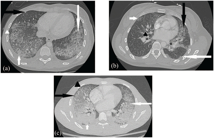 Chest CT for case 1 (image a) demonstrates ground glass opacities (long white arrow), patchy consolidation (short white arrow), crazy paving appearance (white arrowhead) which describes ground glass opacities with septal thickening, nodular foci (black arrow), and subpleural sparing (also white arrowhead). Chest CT for case 2 (image b) displays scattered mostly peripheral ground glass lung opacities (short white arrow) with nodules (long white arrow), septal thickening (black arrow), and peribronchial wall thickening (black arrowhead). Chest CT for case 3 (image c) shows interlobular septal thickening (black arrowhead) and alveolar ground glass opacities (white arrow) throughout much of the lungs with notable subpleural sparing (black arrow), more consolidative opacities in dependent lung bases (small white arrow), and small bilateral pleural effusions.