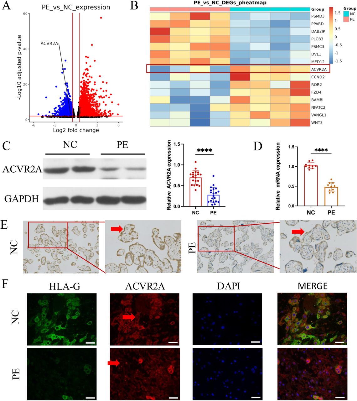 ACVR2A was downregulated in placental tissue associated with pre-eclampsia.(A) Comparison of the RNA-seq volcano maps of all genes in the placenta of normal control (NC) and patients with pre-eclampsia (PE) evidently showed that the expression of the ACVR2A gene significantly decreased in patients with PE.(B) Heatmap of differentially expressed genes in PE versus control placental samples. Genes were selected based on significant differential expression (FDR < 0.05, |log2(fold change) | ≥ 1) and their involvement in the WNT signaling pathway, as determined through KEGG and GSEA analyses. ACVR2A is highlighted alongside other genes of interest to illustrate its association with the molecular landscape of PE.(C) Western blot analysis demonstrated reduced levels of ACVR2A in preeclampsia placental tissue (n = 20) compared with control placentas.(D) RT-qPCR was employed to assess the ACVR2A mRNA expression in placental tissues of normal control (NC, n = 10) and patients with pre-eclampsia (PE, n = 10).(E) Immunohistochemical staining was conducted using rabbit IgG anti-human ACVR2A antibody on sections from normal control and pre-eclampsia (PE) placentas. Sections were counterstained with hematoxylin. The ACVR2A levels were markedly lower in patients with PE (n = 10) than in NC.(F) Immunofluorescence co-localization of rabbit IgG anti-human ACVR2A antibodies and HLA-G antibodies (a marker of extrachorionic trophoblastic cells) was performed in normal control and pre-eclampsia maternal placenta. The expression pattern of the ACVR2A antibody closely resembles that of the HLA-G antibody, primarily expressed in EVT cells.(*P < 0.05, **P < 0.01, ***P < 0.001, and ****P < 0.0001 compared with normal control group).