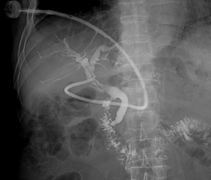 T-tube imaging image 30 days after the first laparoscopic common bile duct exploration with laparoscopic cholecystectomy procedure.