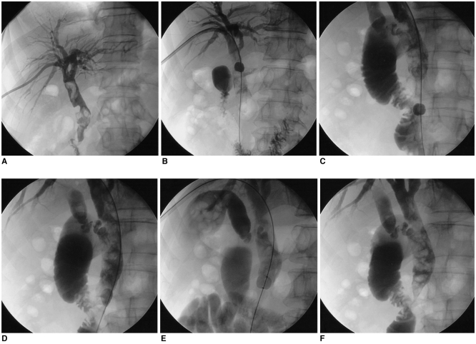 Fifty-six year-old male complaining of fever and right upper quadrant pain.A. Multiple filling defects are seen in Common bile duct, indicating multiple stones. Common bile duct is severely dilated, measuring 16-17 mm in diameter.B-D. Stone evacuation with occlusion balloon failed. The occlusion balloon passed over the stone, unable to push the stones effectively.E. Even a larger sized balloon (13 mm), that is used for endoscopic common bile duct stone removal, fails in pushing the stones.F. Multiple stones still remain in common bile duct.