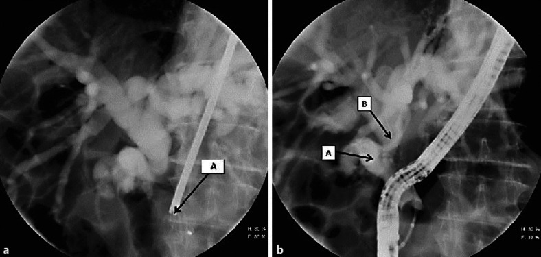 a The stone being crushed with a mechanical basket lithotripter (A). b Dilated cystic duct (A) and CBD (B) after complete stone extraction.