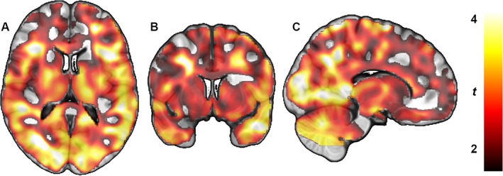 Whole‐brain statistical parametric mapping analysis shows lower type 1 cannabinoid receptor density (distribution volume) in subjects with Parkinson's disease compared with healthy control subjects. Color bar represents t value, which corresponds to the level of significance at the voxel level. (A) Transaxial section. (B) Coronal section. (C) Sagittal section.