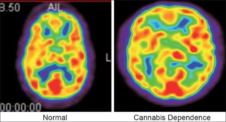 Representative PET images from single subjects of each group illustrating differences in regional glucose uptakes among the various brain regions