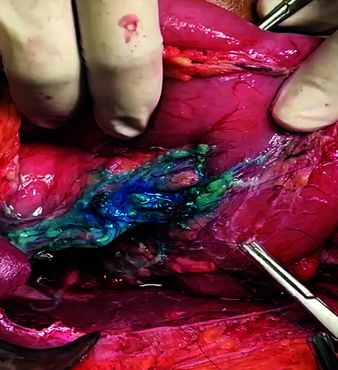 Image depicting the closed distal biliary stump in the postero-superior part of pancreas with interrupted fine absorbable sutures; the distal stump was closed with a pancreatic probe in situ