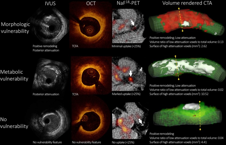 Intravascular ultrasound, optical coherence tomography, 18F-sodium fluoride-PET, and volume-rendered coronary computed tomography angiography images of three representative coronary lesions to assess plaque vulnerability. Morphologic vulnerability was defined as the presence of positive remodeling and posterior attenuation on intravascular ultrasound (IVUS) and the presence of thin-cap fibroatheroma (TCFA) or intraplaque microvessels or macrophage infiltration on optical coherence tomography (OCT). Metabolic vulnerability was defined as any plaque showing > 25% uptake on 18F-sodium fluoride-PET (NaF18-PET) images. Upper row depicts a plaque showing morphologic characteristics of vulnerability. Middle row shows a lesion with metabolic characteristics of vulnerability. Bottom row displays a plaque showing neither morphologic nor metabolic characteristics of vulnerability. Image courtesy of M. Kolossvary. CTA, computed tomography angiography