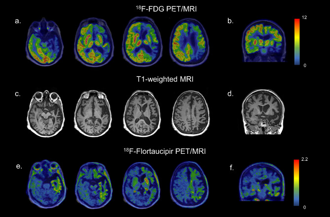 Axial (a) and coronal (b) slices of [18F]FDG PET showing severe asymmetric hypometabolism in the left frontotemporoparietal cortex and in the left caudate nucleus and in the left putamen. Axial (c) and coronal (d) T1-weighted MRI images show supra-tentorial asymmetric brain atrophy, predominating on the left side. Axial (e) and coronal (f) [18F]flortaucipir PET images show a mildly increased tracer uptake in areas characterized by hypometabolism.Images are in radiological orientation