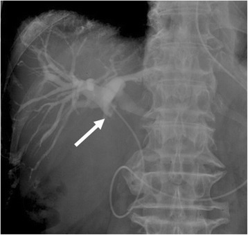 Cholangiopancreatography findings. Cholangiography revealed severe intrahepatic bile duct dilatation and a filling defect in the mid-CBD (arrow). The tumor involved with the cystic duct