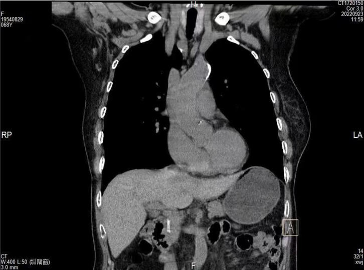 Computed tomography coronal view shows a strip of high-density shadow in the common bile duct.