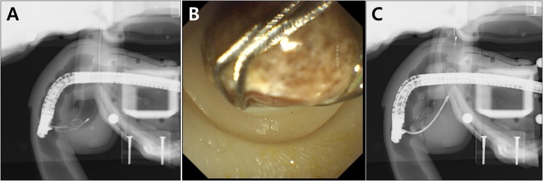 Biliary stone extraction and mechanical lithotripsy. a Fluoroscopic image of biliary stone extraction using the CBD dilation module; b Endoscopic image of biliary stone extraction without sphincterotomy; c Fluoroscopic image of mechanical lithotripsy using the distal stricture and proximal dilation of the CBD module
