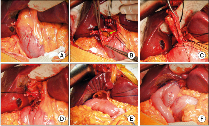 Intraoperative photograph showing the procedure of end-to-end choledochojejunostomy with segmental resection of the common bile duct (CBD) in Case No. 2. (A) The dilated CBD is visible after cholecystectomy. (B) The mid-portion of the CBD is incised longitudinally, showing multiple CBD stones and sludges. (C) The distal CBD is dissected and transected at the narrow portion of the intrapancreatic bile duct, and then securely closed with 5-0 Prolene sutures. (D) The proximal CBD was also transected at the level of the right hepatic artery to make a large proximal bile duct opening. (E, F) A Roux-en-Y jejunal limb is anastomosed to the CBD opening in an end-to-side fashion.