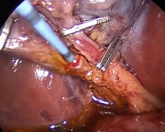 A cholangio-catheter used to catheterize the cystic duct