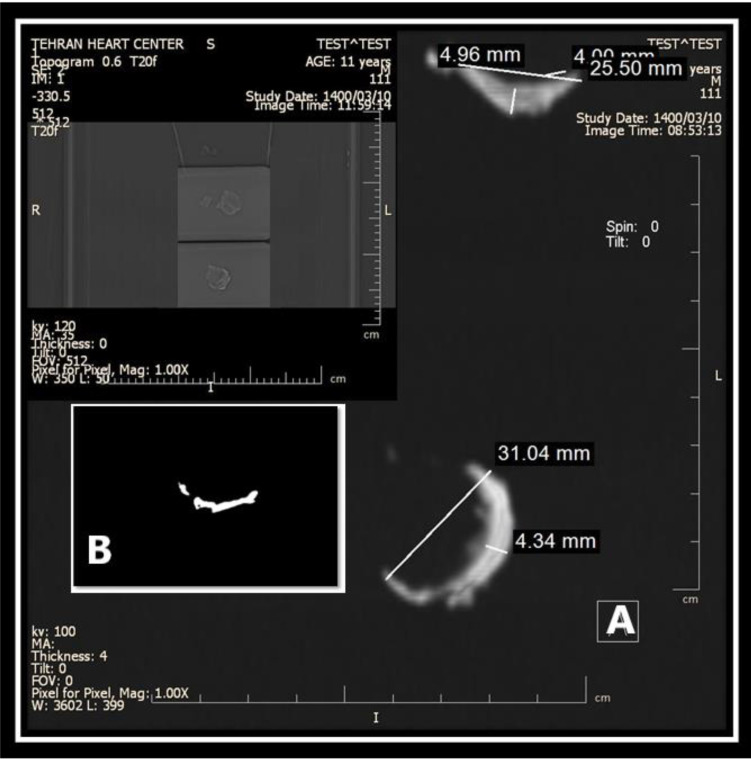 A: Dual energy dual source CT using SOMATOM Definition Flash (Dual-Source) Siemens 2009 shows the presence of laminated layer B: Low-resolution regular 16 slice single source spiral CT shows the calcified cyst wall
