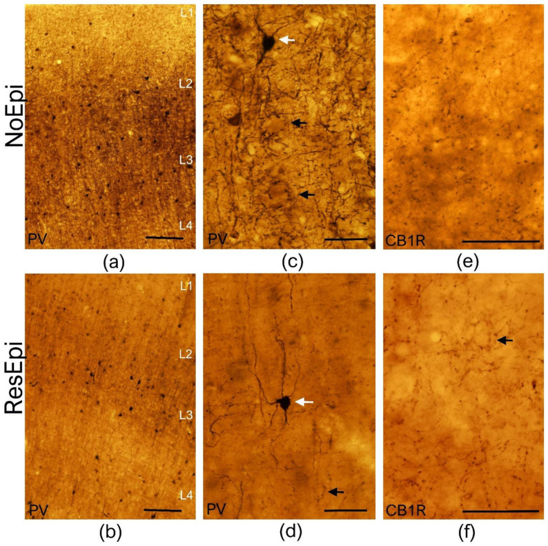 Light microscopy of the human temporal neocortex. Low magnification light microscopic images show the distribution of PV-positive elements in the human temporal neocortex derived from NoEpi (a) and ResEpi (b) slices. Numerous PV-positive interneurons were found scattered throughout the neocortical layers both in NoEpi and in ResEpi samples. High magnification images (c,d) show that PV stains multipolar neurons with aspiny dendrites (white arrows on (c,d)), and a homogeneous axonal meshwork. A dense axonal bundle is visible in layer 3 in the neocortex of both NoEpi (a,c) and ResEpi (b,d) patients. Black arrows point to the typical basket formations of PV-stained axons. CB1R is expressed only in axons of perisomatic cells in the non-epileptic (e) and epileptic (f) human neocortex. The axonal cloud was homogeneous in layer 2/3, and several basket formations were visible (black arrow on (f)). Scale bars: (a,b): 200 µm, (c–f): 50 µm.