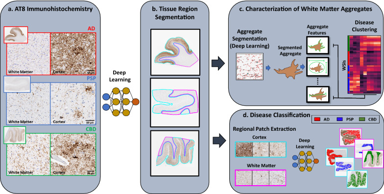 Schematic of analysis workflow. a Example images of AT8-stained WSI from AD, PSP, and CBD patients that form the basis of our analysis. b Pathologist annotation of cortex(cyan), white matter (magenta) and background (no color) regions were used to train a deep-learning model to segment these regions in WSI. c Characterization of white matter aggregates: A pathologist trained deep learning model was used to segment aggregates in the white matter, and for each aggregate, multiple features characterizing its size and shape were extracted. We then performed unsupervised analyses to test whether white matter aggregates in WSI from the same disease were more similar than those from different diseases. d Disease classification based on cortex and white matter: Separate deep learning models were trained for the cortex and white matter to predict disease status directly from image patches (without need for any human curation of features) and the performance of these two models was compared and contrasted