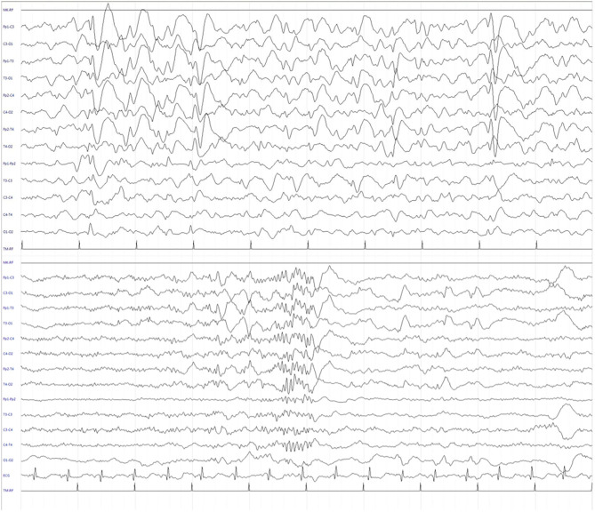 Electroencephalogram (EEG) during sleep after 3 months of CBD treatment. The recording showed a significant reduction of EEG abnormalities in frequency and amplitude, and the presence of sleep figures, including sleep spindles.