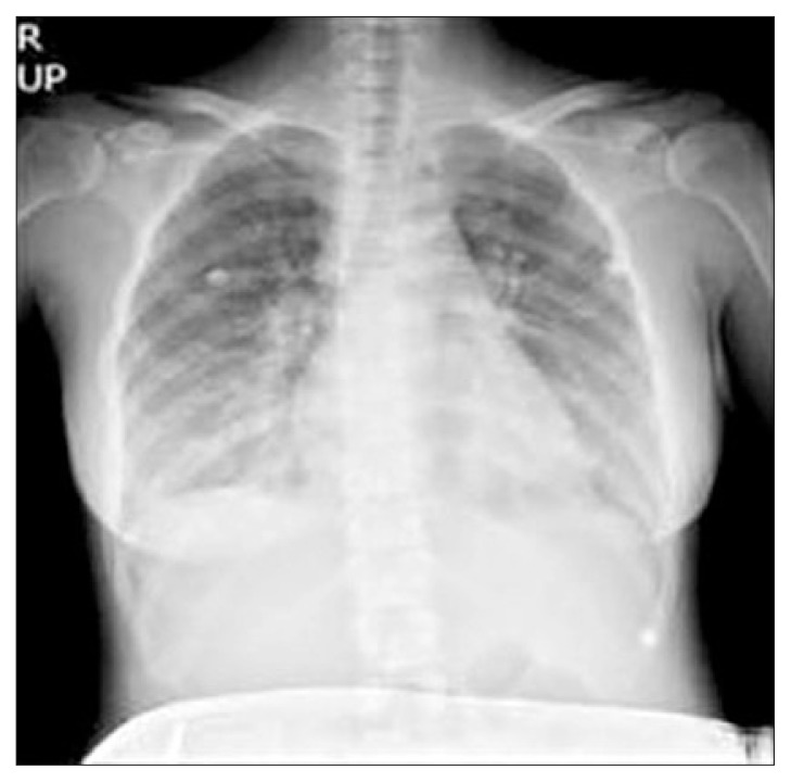 After an endoscopic ultrasonography-guided procedure, pulmonary edema occurred (case 11).