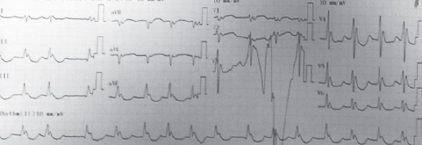 When first admitted, the hypothermic patient's ECG demonstrated Osborn waves and atrial fibrillation
