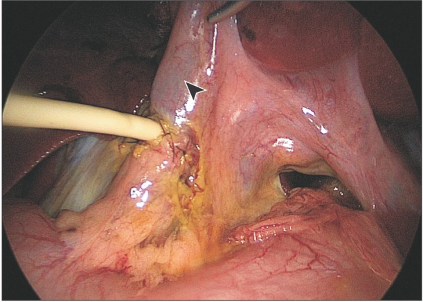 The bile leakage test was done to confirm the secureness of anastomosis after closure of common bile duct incision. A salin solution of the dye (arrowhead) was flushed through the T-tube to rule out leakage.