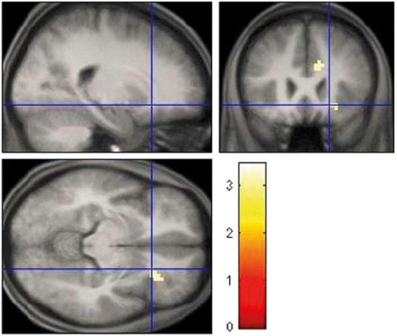 Increased right insula activation for feedback gain in smoking vs. cannabis-dependent individuals.