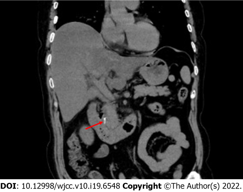 Abdominal computed tomography demonstrated hyperdense material in the common bile duct corresponding to the migrated Hem-o-lok clips.