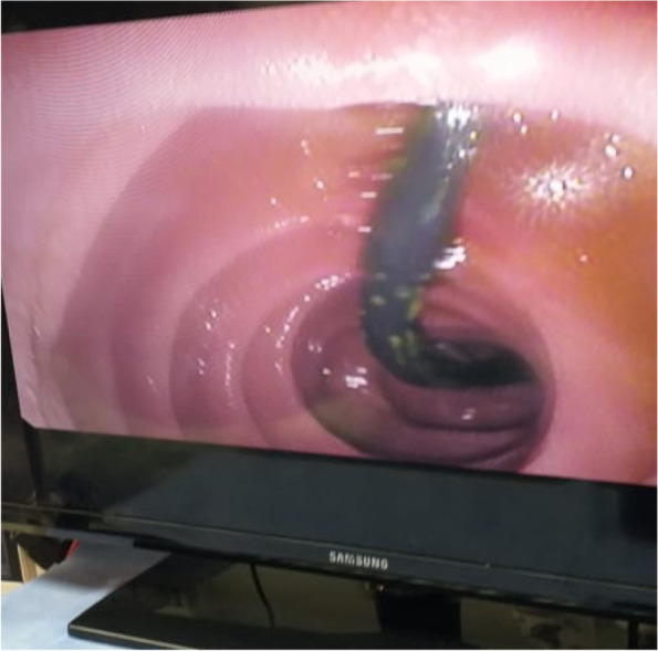 The slipped surgical catheter