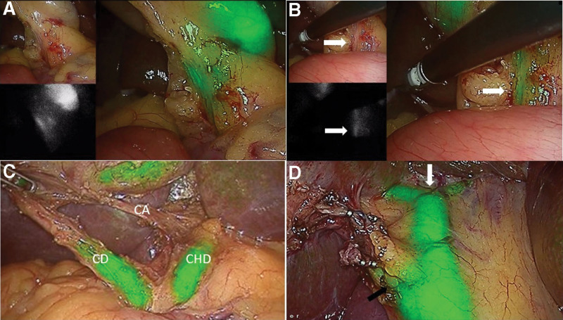 (a) ICGF at the beginning of dissection of hepatocystic triangle showing real time laparoscopic image in left upper corner, NIRF in left lower corner and NIRFA on right side; (b) Instrument passed from epigastric port representing the line drawn from falciform ligament to the right end of Rouviere’s sulcus showing the CBD below the instrument, white arrow showing CBD; (c) ICGF during demonstration of critical view of safety; (d) ICGF showing extrahepatic biliary tree at the conclusion of laparoscopic cholecystectomy, white arrow showing confluence of right and left hepatic ducts at hilum, black arrow showing cystic duct and CBD junction. CBD = common bile duct, ICGF = ICG fluorescence, NIRF = near-infrared fluorescence, NIRFA = near infrared fluorescence augmented.