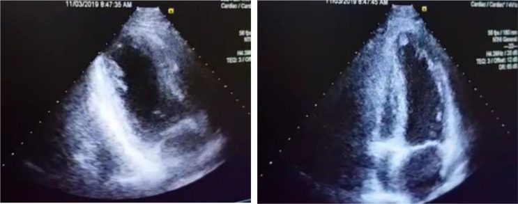 Follow-up echocardiogram showing a small clot in cardiac apex.
