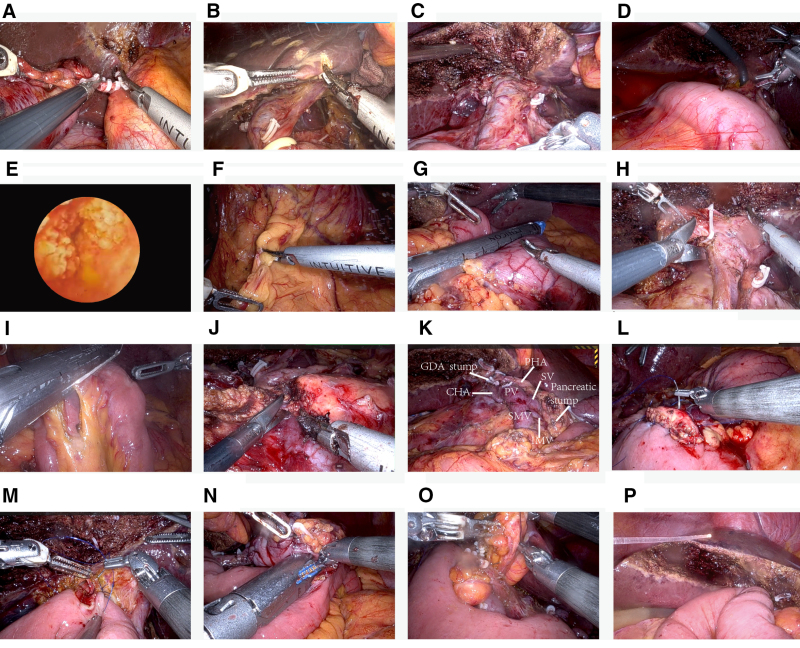 Robotic pancreatoduodenectomy procedure. (A) The cystic duct was transected. (B) The liver parenchyma located 2–3 cm from the gallbladder fossa was demarcated. (C) A wedge resection of the hepatic parenchyma in segments IVb and V was performed. (D) Choledochoscopic exploration of the biliary tree was performed. (E) An obstructing mass was identified in the distal common bile duct. (F) The gastrocolic ligament was divided. (G–J) The stomach (G), ductus hepaticus communis (H), jejunum (I), and pancreas (J) were sequentially transected. (K) The overall surgical field view after specimen transection. (L–N) Pancreaticojejunostomy (L), hepaticojejunostomy (M), and gastrojejunostomy (N) were performed sequentially. (O) Shell-like encasement of the hepatic artery. (P) Drainage pipes were placed in the surgical field. CHA = common hepatic artery, GDA stump = gastroduodenal artery stump, IMV = inferior mesenteric vein, PHA = proper hepatic artery, PV = portal vein, SV = splenic vein.
