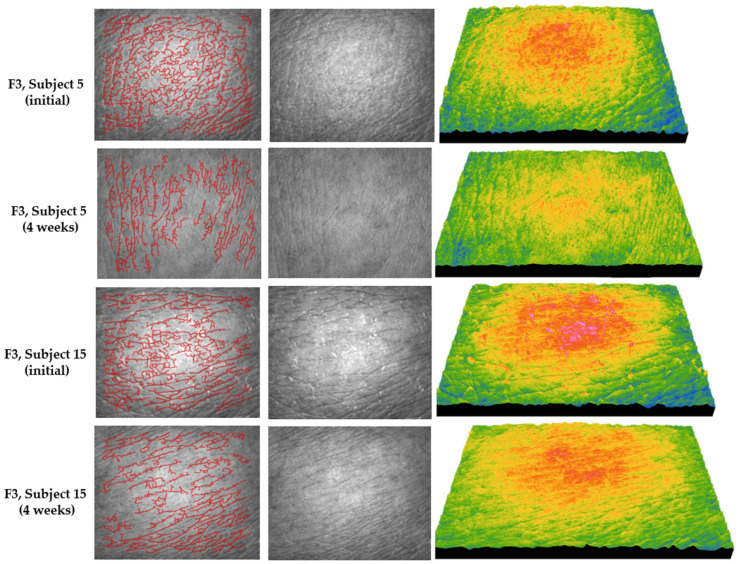 Representative images of skin topography recorded for formula F3 in subject no. 5 (age 26) and subject no. 15 (age 47) at baseline and after 4 weeks of treatment; the images include the wrinkle line map (left), grayscale images of the skin surface (middle), and 3D images of the skin microrelief (right).