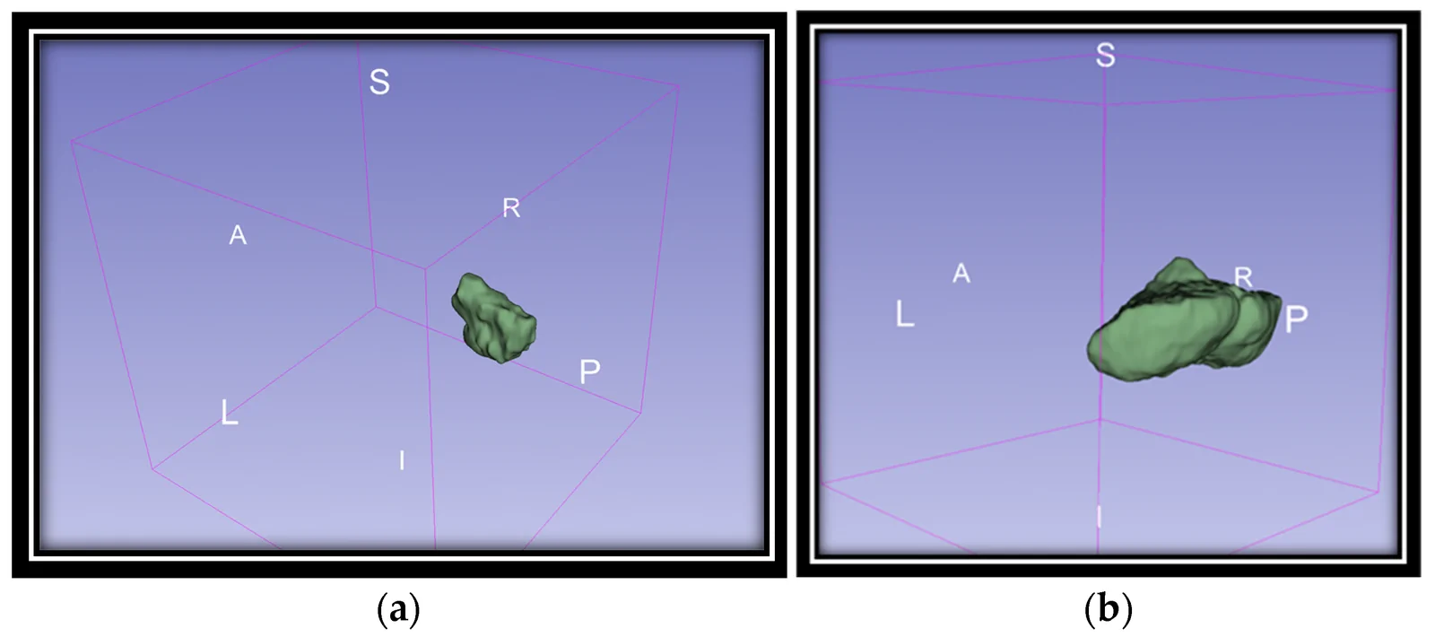 Three-dimensional manual segmentation (3D Slicer) at baseline thin-slice CT showing structural boundaries of the (a) cerebellar vermis and (b) total cerebellum prior to LAI aripiprazole initiation.