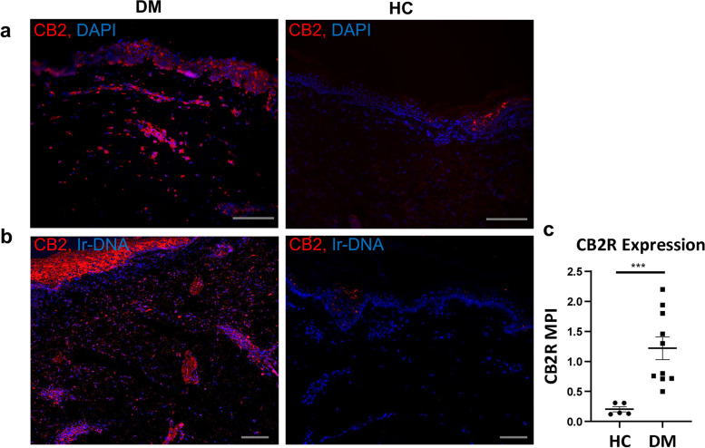 CB2R upregulation in dermatomyositis compared to healthy control. Skin biopsies stained via a immunofluorescence demonstrate CB2R (red) expression in DM skin compared to HC skin. Nuclei stained with dapi. b IMC demonstrates CB2R (red) expression in DM skin compared to HC skin. Nuclei stained with Ir-DNA. c Quantification of IMC CB2R expression in DM lesional skin compared to HC skin, excluding epidermis. Scale bars (gray) = 100μm. Graph shows median ± IQR. ***p<0.001. DM, dermatomyositis; HC, healthy control; IMC, image mass cytometry, iridium intercalator (Ir-DNA); MPI, mean pixel intensity
