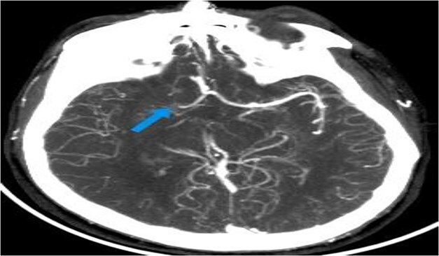 Axial CTA image of the brain showing abrupt cutoff of the right middle cerebral artery (MCA) at the M1 segment (arrow), with reduced opacification of its distal cortical branches. These findings are suggestive of a right MCA occlusion.